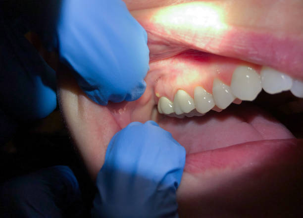 Best Dentist for Tooth Abscess  in Creswell, OR